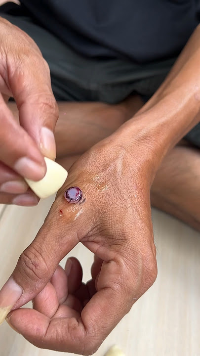 EASY WAY TO REMOVE WARTS #trending #shortvideo #diy #viral #medicine #shorts #KaryaJangyaya