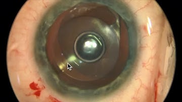 DMEK Basics 10   Minibubble centration