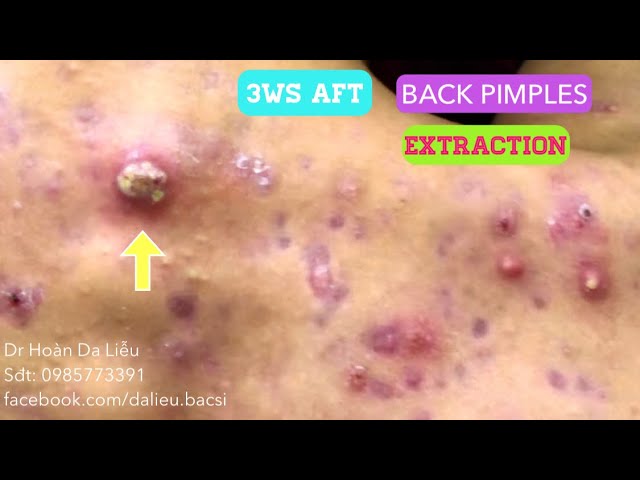 Mụn nhọt mủ lưng siêu nặng|Big acnes pimples,pusstule,blackheads before 3ws after extraction