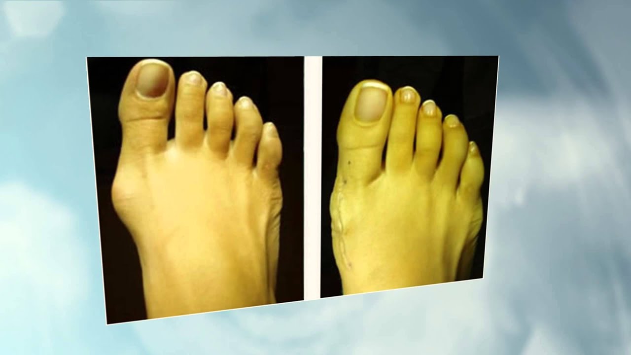 Professional Foot and Ankle Care Deerfield Beach Florida YouTube