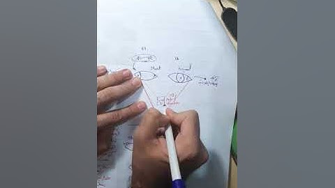 squint 4 (paralytic squint) - dr Ahmed Ashraf