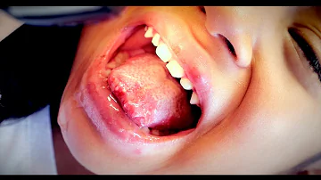 BAD TONGUE SORES! (Herpes Stomatitis) | Dr. Paul
