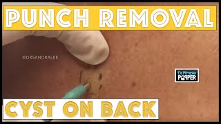 Punch Removal Of A Cyst On A Patient With Tinea Versicolor
