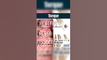 TORQUE - ORTHODONTIC TIPS #Shorts