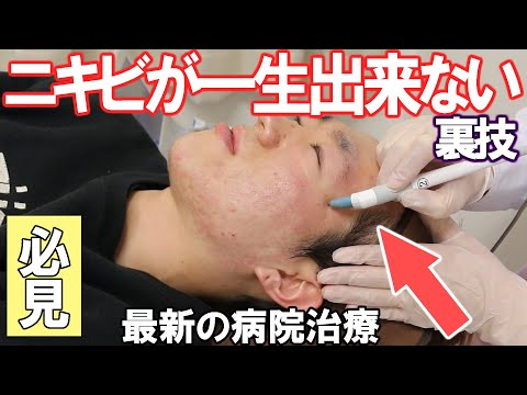 【最強説】ニキビに悩む人必見!!ガチの病院治療で一生ニキビが出来ない肌に！