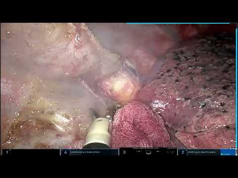 Robotic single site surgery for posterior mediastinal tumor