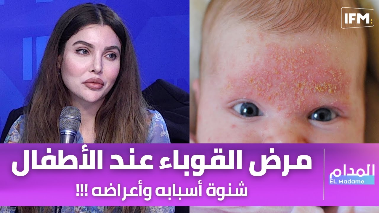 مرض القوباء عند الأطفال شنوة أسبابه وأعراضه أكثر تفاصيل مع اخصائية الأمراض الجلدية والتناسلية