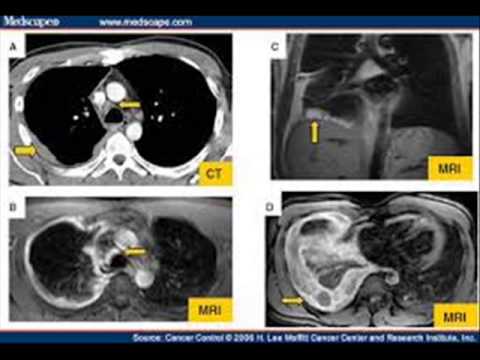 mesothelioma. ct..... s - YouTube