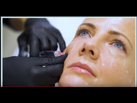 Video: Botox Vs. Fyllstoffer: Hva Er Forskjellen?