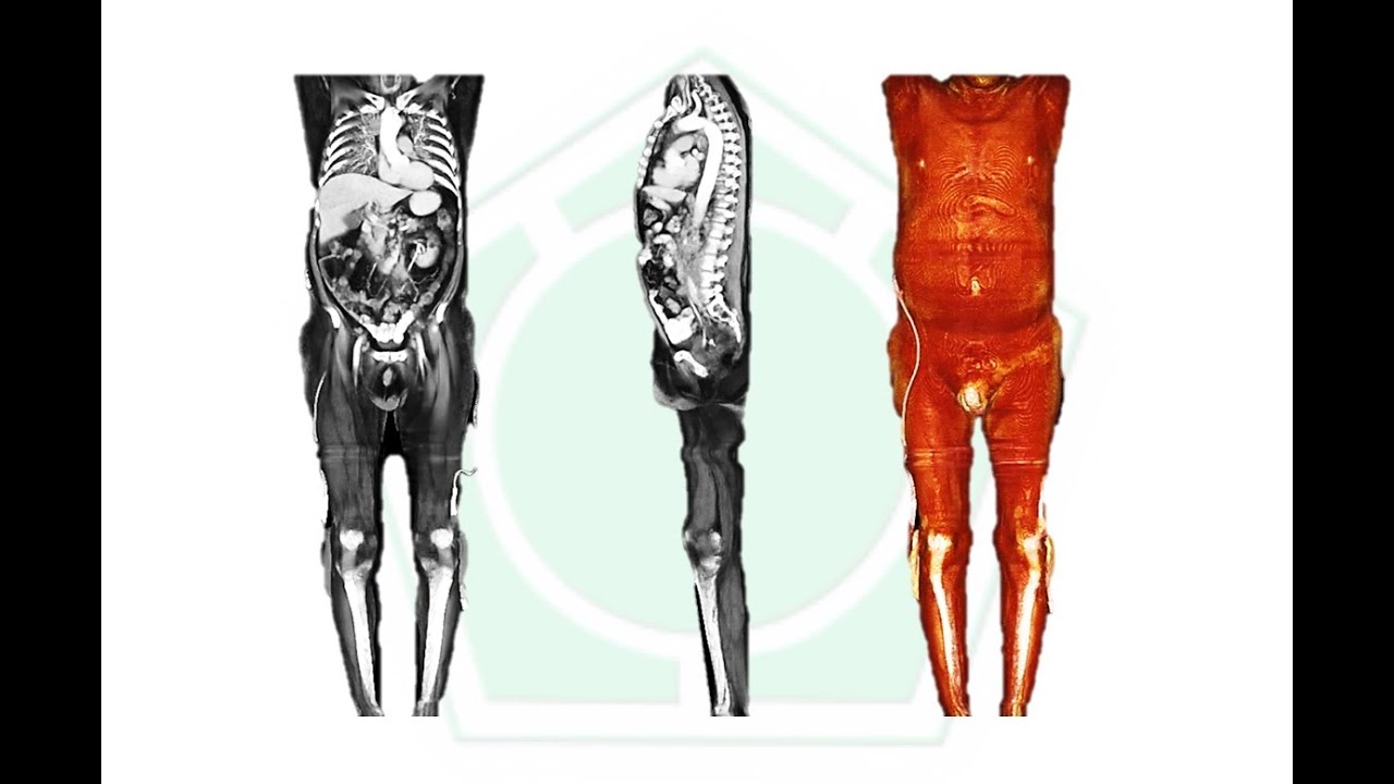 Diagnóstico por Imagen Tomografia de Cuerpo Completo