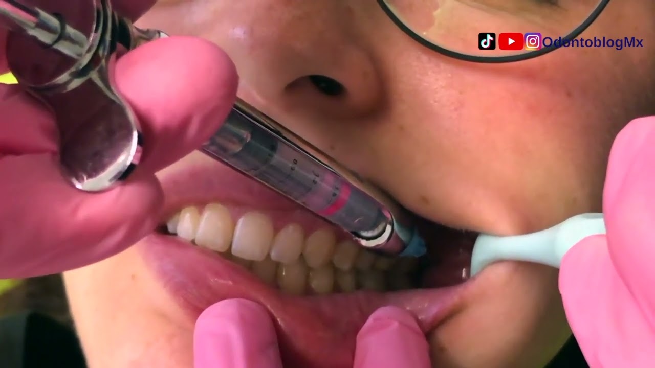 Técnica de Anestesia Vazirani- Akinosi ó a boca cerrada