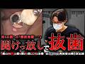 【開けっ放しが抜歯を招く】治らぬ膿への「開放処置…」再根管治療の全記録(最後におまけ映像あり)