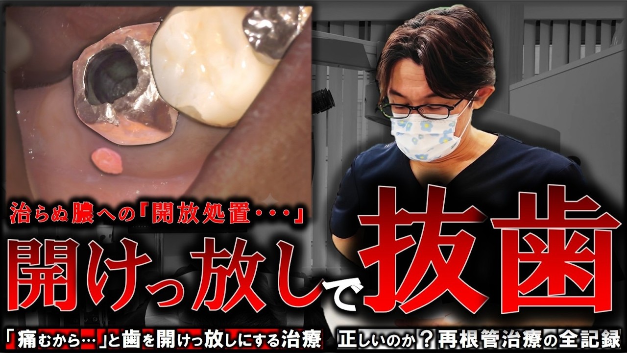 【開けっ放しが抜歯を招く】治らぬ膿への「開放処置…」再根管治療の全記録(最後におまけ映像あり)