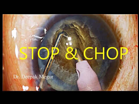 Phaco Basics - Stop & Chop Technique in a hard Cataract