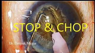 Phaco Basics - Stop & Chop Technique in a hard Cataract