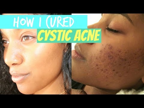 How I cured Cystic ACNE!!