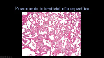 O que é pneumonia intersticial idiopática?