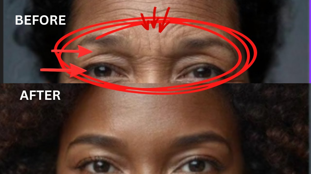 Forehead Wrinkles and Hooded Eyes Gone ! No Needles  | No Eye Surgery