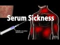 Serum Sickness: Pathophysiology, Symptoms, Causes, Treatment, Animation
