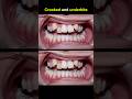 Braces change your smile. 50 months duration #braces #dentist #orthodontist