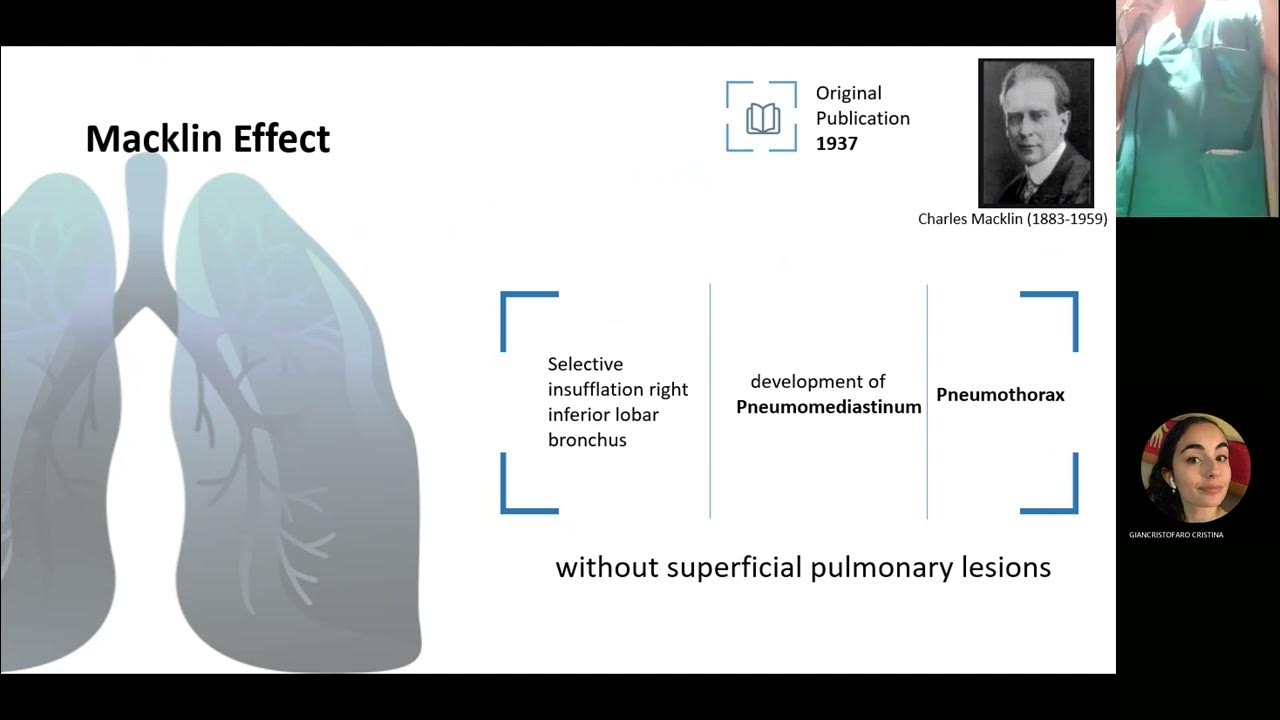 "Macklin effect in Covid19 patients" ft Professor Giovanni Landoni