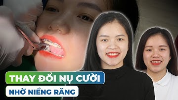 Thay Đổi Nụ Cười Toàn Diện Sau Tháo Mắc Cài Niềng Răng