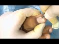 🚨 EXTREME INGROWN TOENAIL REMOVAL 😱 | #SATISFYING #TOENAIL #PEDICURE