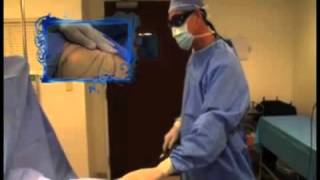 6. Laser Assisted Lipolysis Procedure - Liposuction (SmartLipo)