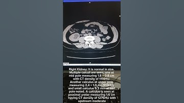 Ct scan reporting KUB #radiology #ctscan #ultrasound #radiologytutorial