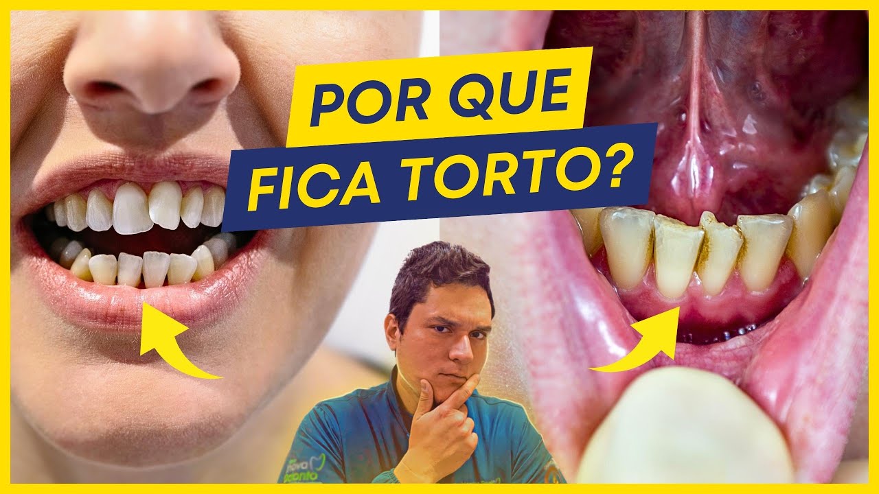 quais-s-o-as-5-principais-causas-dos-dentes-tortos-youtube