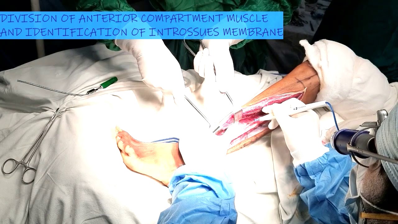 Free Fibula Flap harvest (Extended Video) and Osteotomy technique.