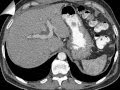 Tomografía y Endoscopia de Linfoma del Duodeno