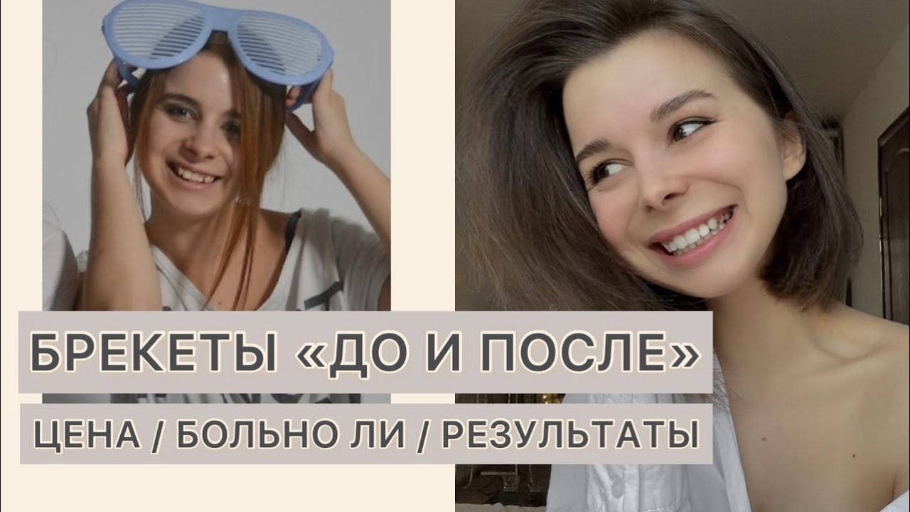 БРЕКЕТЫ ДО И ПОСЛЕ (МОЯ ИСТОРИЯ) / ВСЁ ПРО БРЕКЕТЫ / ИСТОРИЯ МОИХ ЗУБОВ / БОЛЬНО ЛИ
