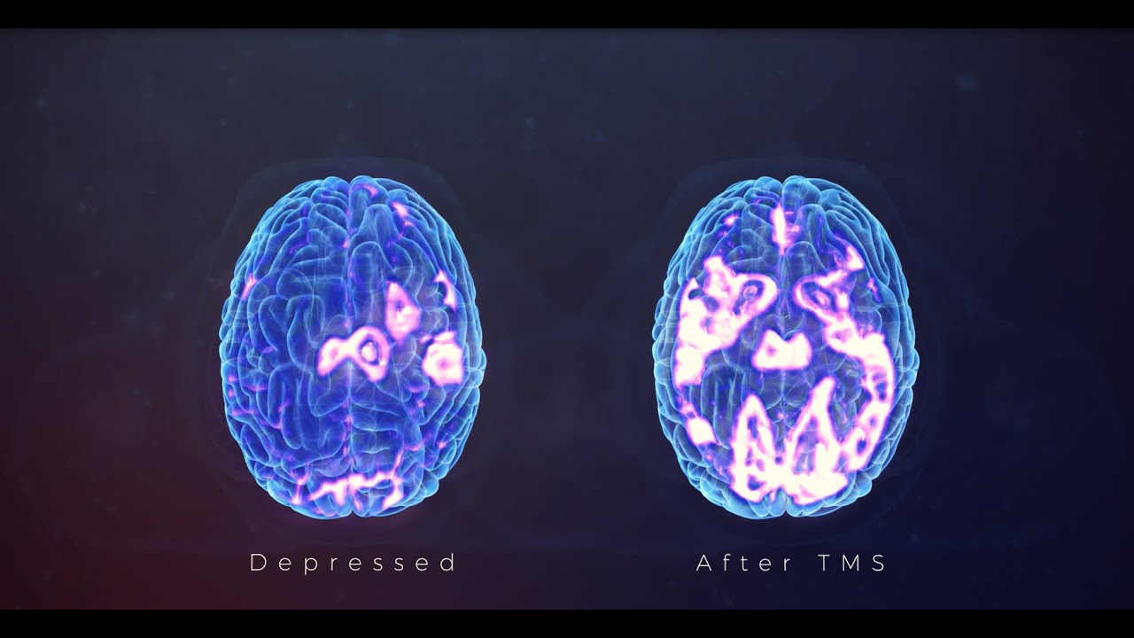 What is TMS - Dr. Liker