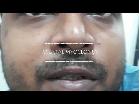palatal myoclonus