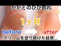 【かかとのガサガサひび割れ】削らないで1ヶ月クリームを塗り続けた結果