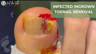 INFECTED INGROWN TOENAIL REMOVAL