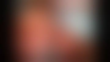 Robotic IVC Thrombectomy Right Side - Stifelman