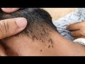 How to comb head lice  clear thousand head lice quickly