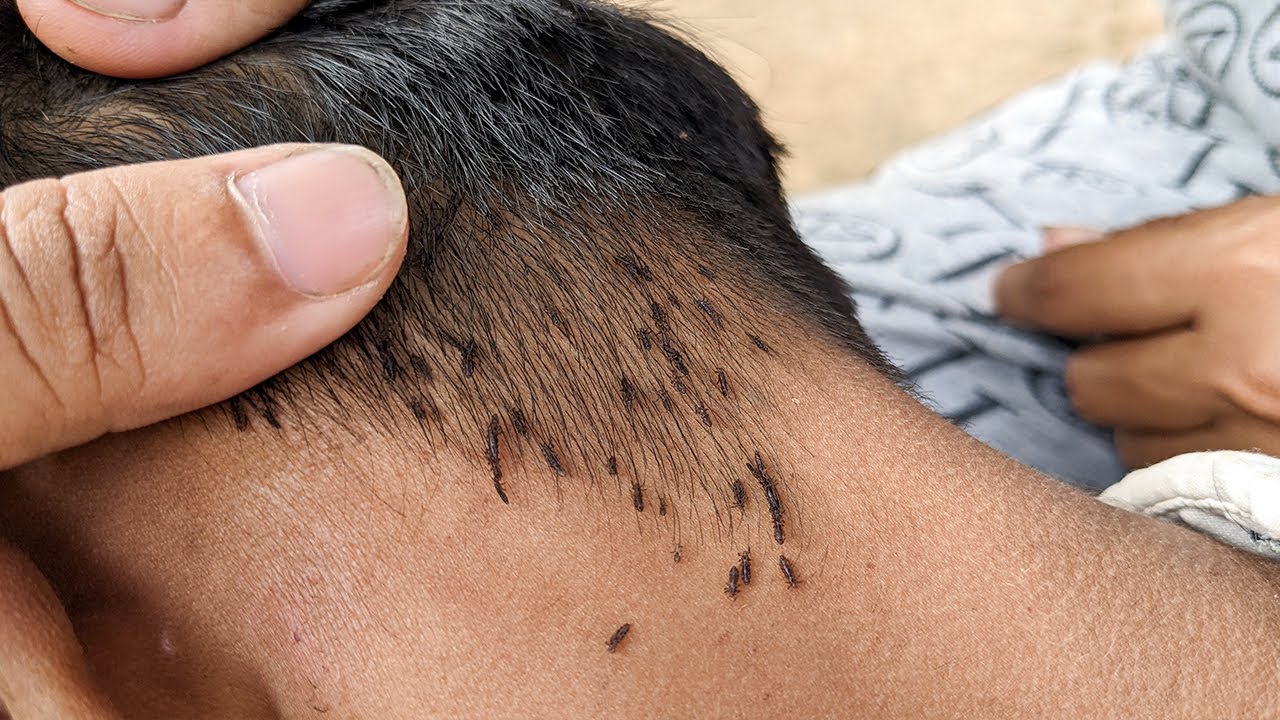 removing thousand of lice from head getting all  lice out black long hair