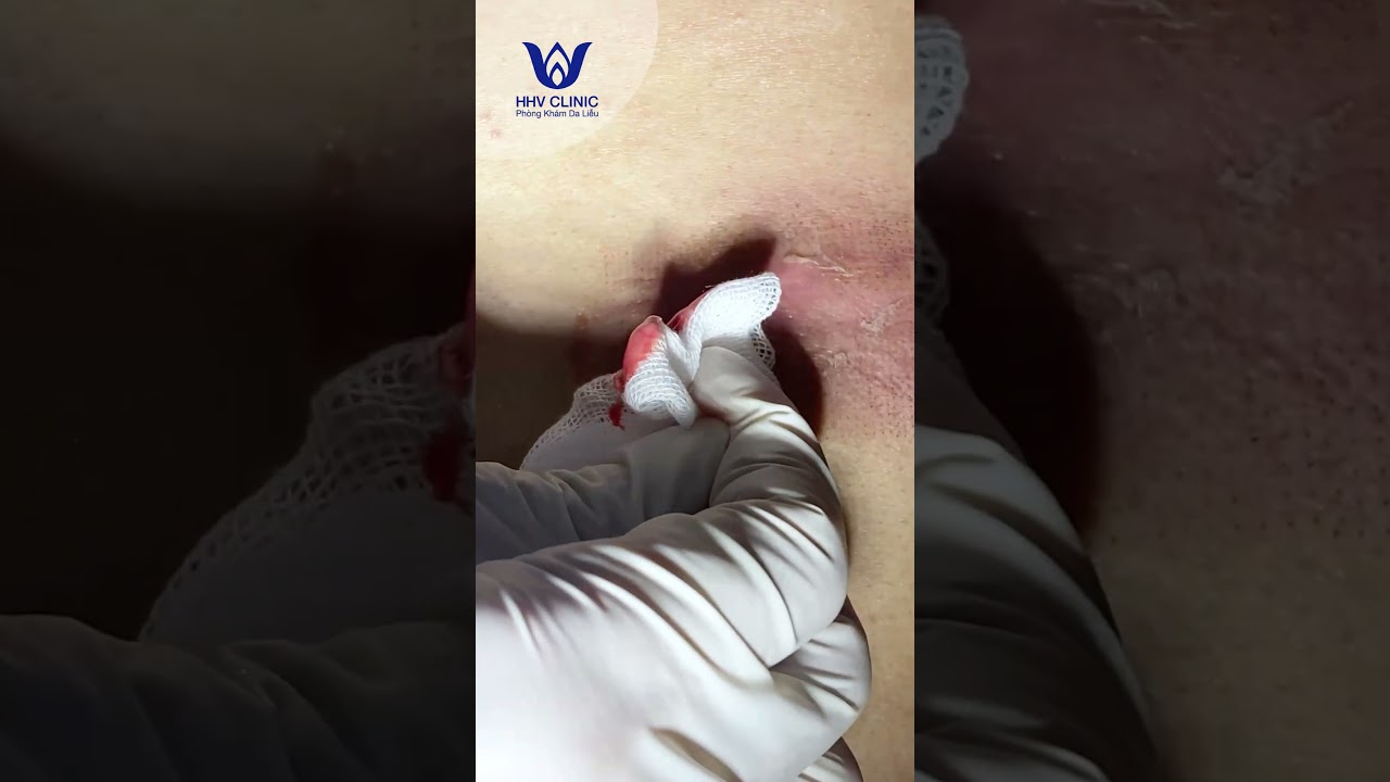 Nặn mụn áp xe nhiều dịch mủ ở lưng.