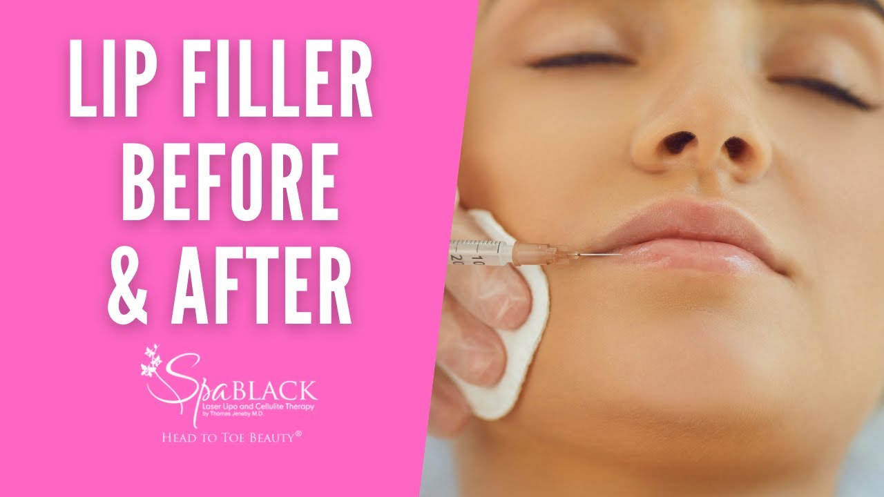 lipo c injections san antonio Lipo-Extreme Shots Specialist Near Me in Antonio, TX MedSpa San Antonio: Body Contouring,