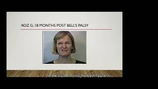 לפני ואחרי טיפול פיזיותרפי בשיטת Facial Retraining עי המומחית Jackie Diels