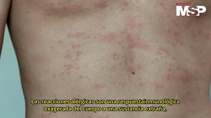 Reacciones alérgicas | ¿Cómo actúa el cuerpo?