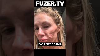 Brandi Glanville’s Face Burns &amp; Real Housewives Drama