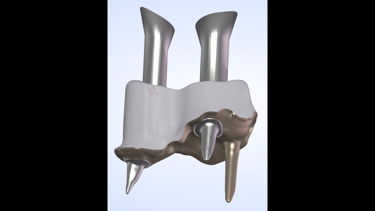 Модуль короны - Изготовление разделенного столба с двумя штифтами.