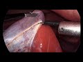 Smooth cholecystectomy
