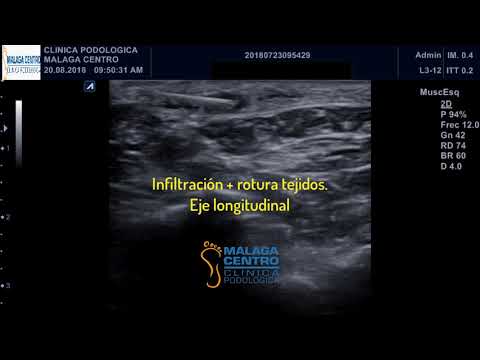 Vídeo: Fibroma Plantar: Síntomas, Tratamiento Y Más