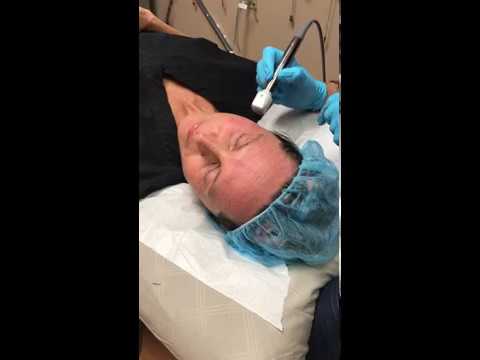 Dallas, TX | Live Fractora Procedure | Tricia Shimer, M.D.