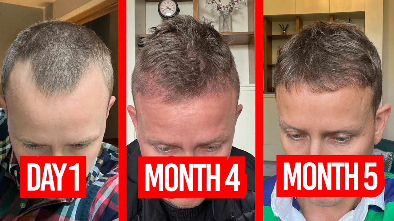 i-got-a-hair-transplant-6-month-update-youtube
